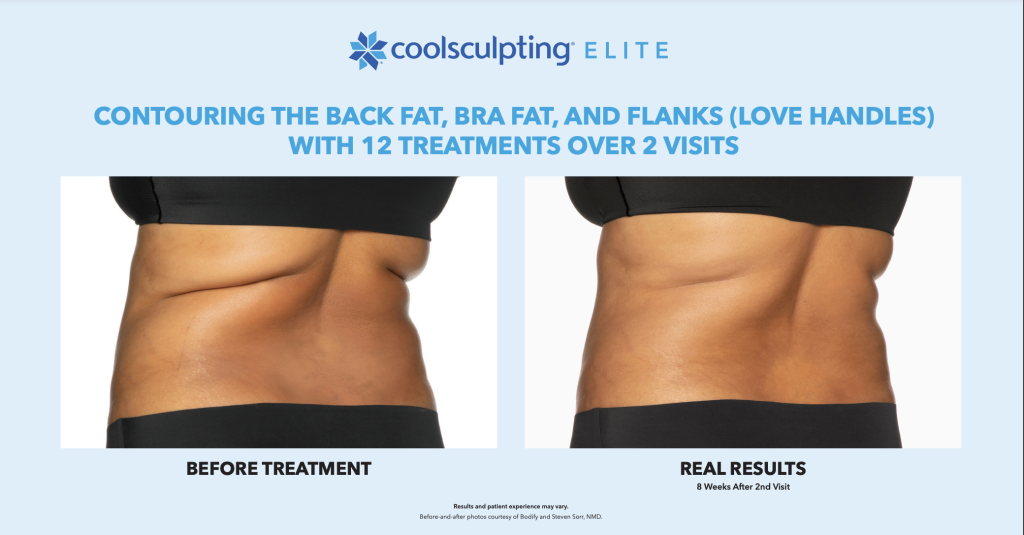 Coolsculpting Elite before and after by Bella Excellence